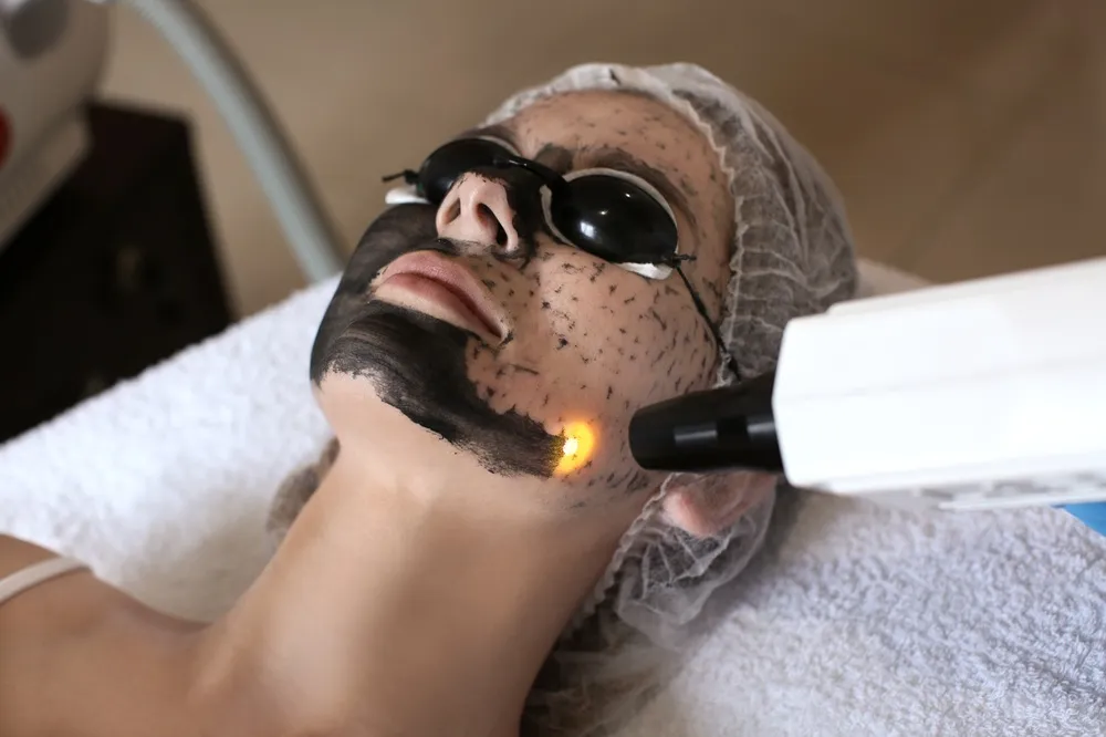 Carbon Doll Facial
