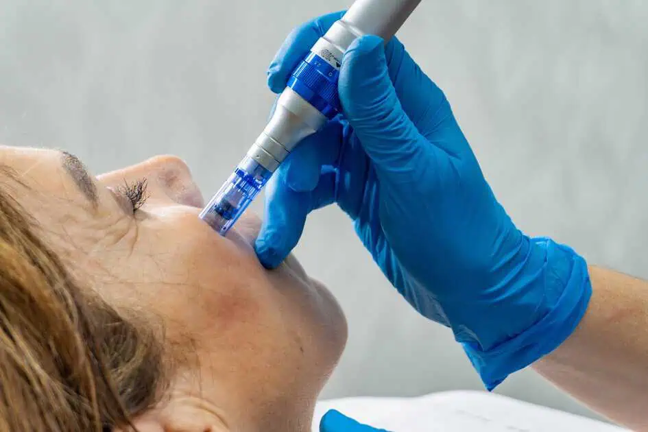 Microneedling Treatments by Body Hub Med Spa in Harbor City, CA